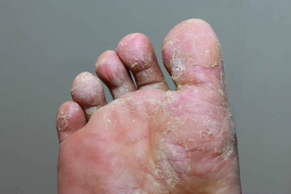 Types of Foot Fungus